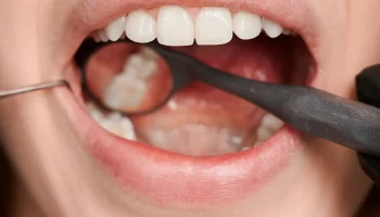 Dental Fillings: Excellent Restorations for Permanently Damaged Teeth