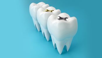 When Do You Need a Dental Filling? Signs You Shouldn’t Ignore